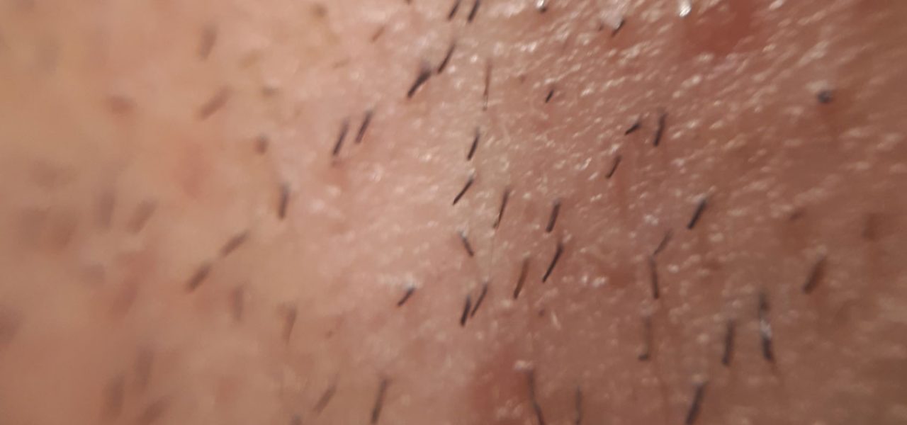 What are ingrown hairs